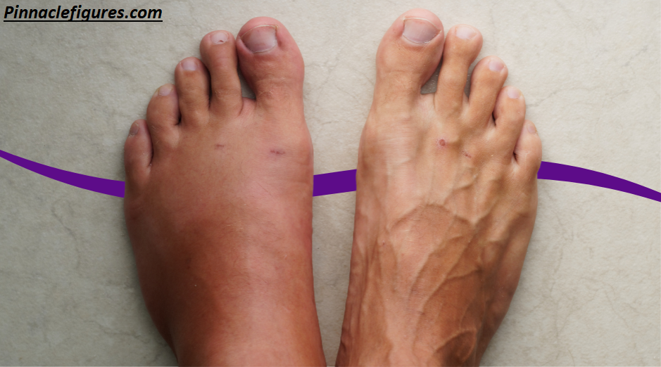 Why Do Ankles Swell? 15 Causes, Warning Signs & Doctor-Approved Remedies