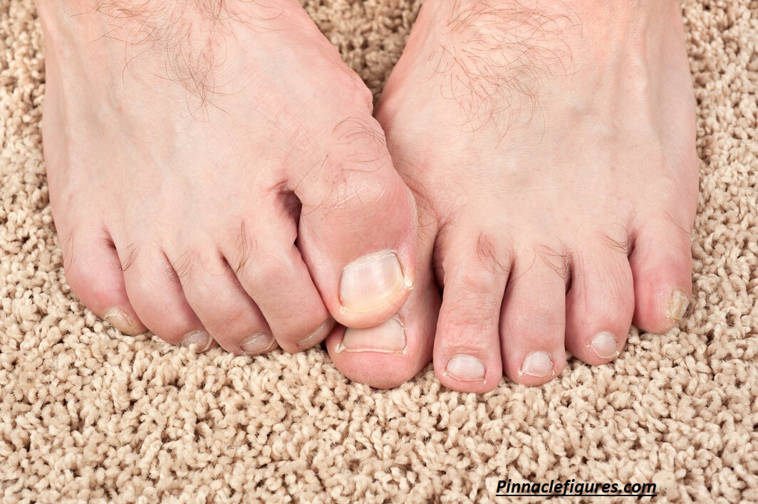 Why Is My Toenail Yellow? Causes, Treatments, and When to See a Doctor