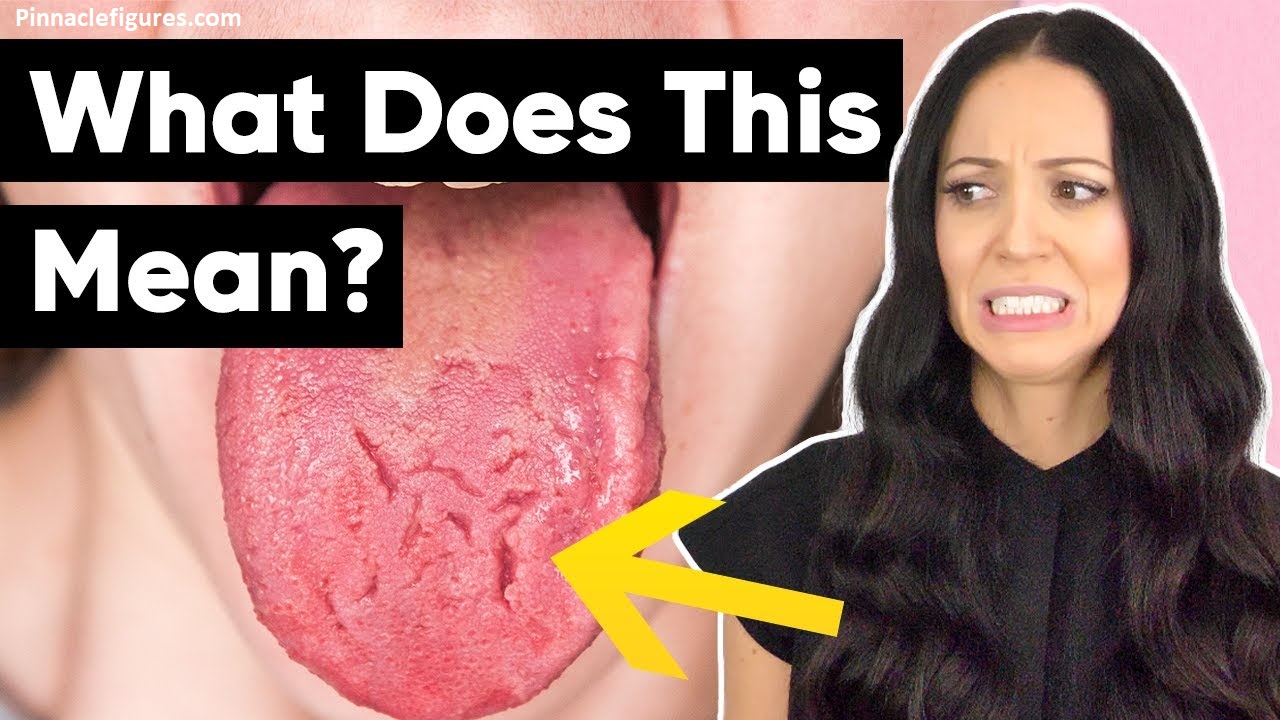 Why Is My Tongue Cracked? Here's What Nobody Tells You