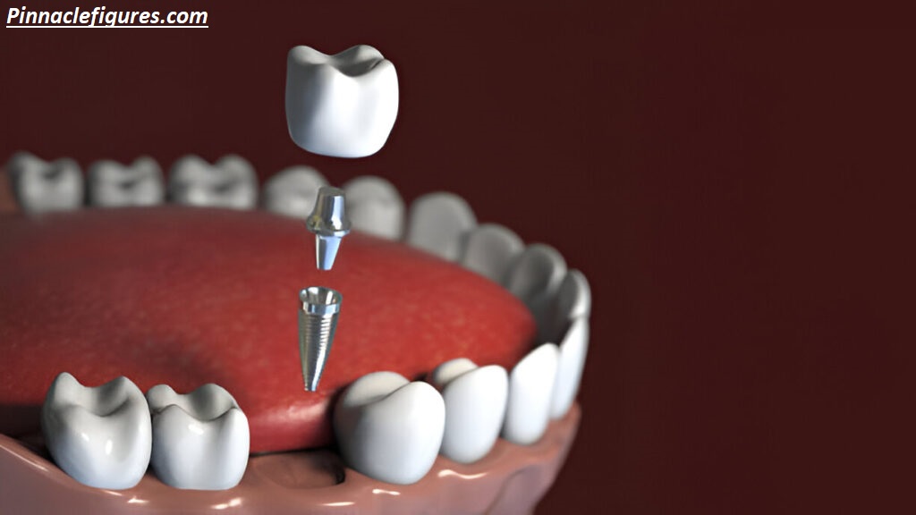 Why No Dairy After Dental Implant? The Real Reason Dentists Recommend Avoiding Milk, Cheese, and Yogurt